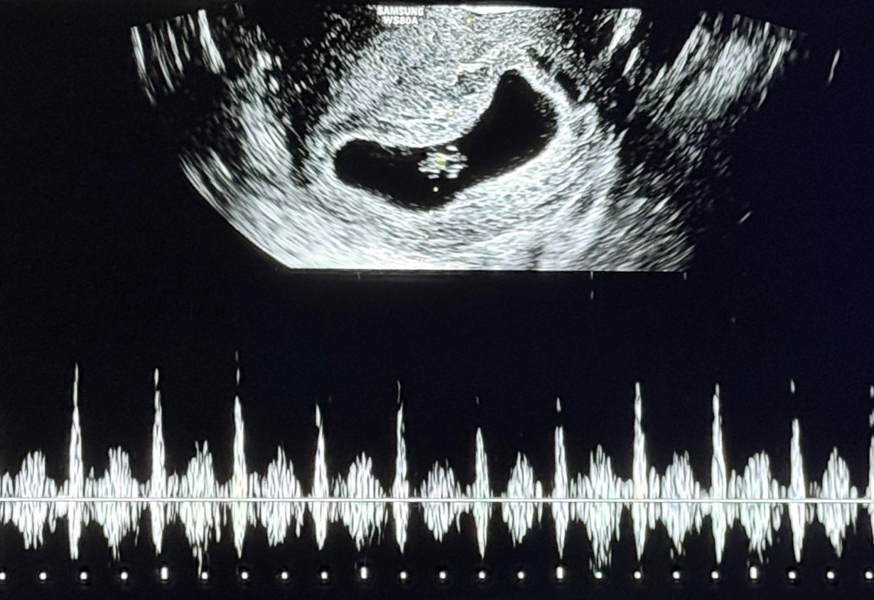 Foto do ultrassom do bebê